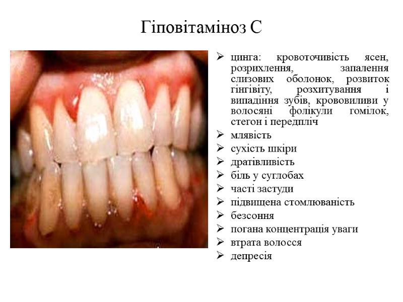 Гіповітаміноз С цинга: кровоточивість ясен, розрихлення, запалення слизових оболонок, розвиток гінгівіту, розхитування і випадіння